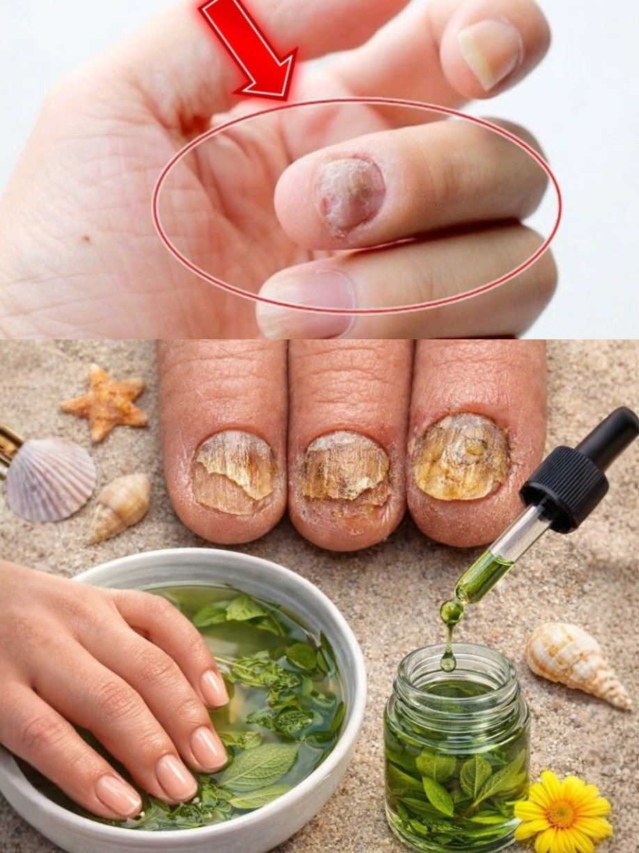 ¡Adiós Hongos para Siempre! El Secreto Natural 'Rompe Hongos' Que NADIE Te Contó (y Cómo Usarlo Bien)