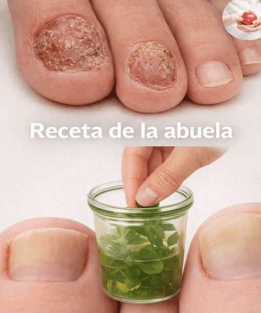 El Secreto del "Rompe Hongos" Revelado: Recupera la Salud Natural de Tus Uñas