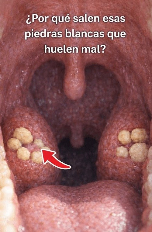 ¡ALERTA! Si Tienes Estas Bolitas Blancas con Mal Olor en tu Boca, DEBES Saber Esto AHORA