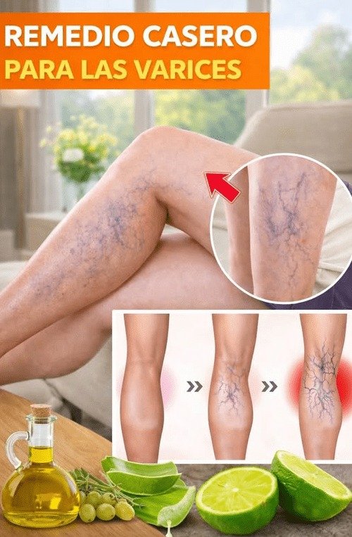 ¿Cansada de Várices y Piernas Hinchadas? El Hábito Casero de 3 Ingredientes que tus Abuelas Guardaban en Secreto (¡Y funciona!)