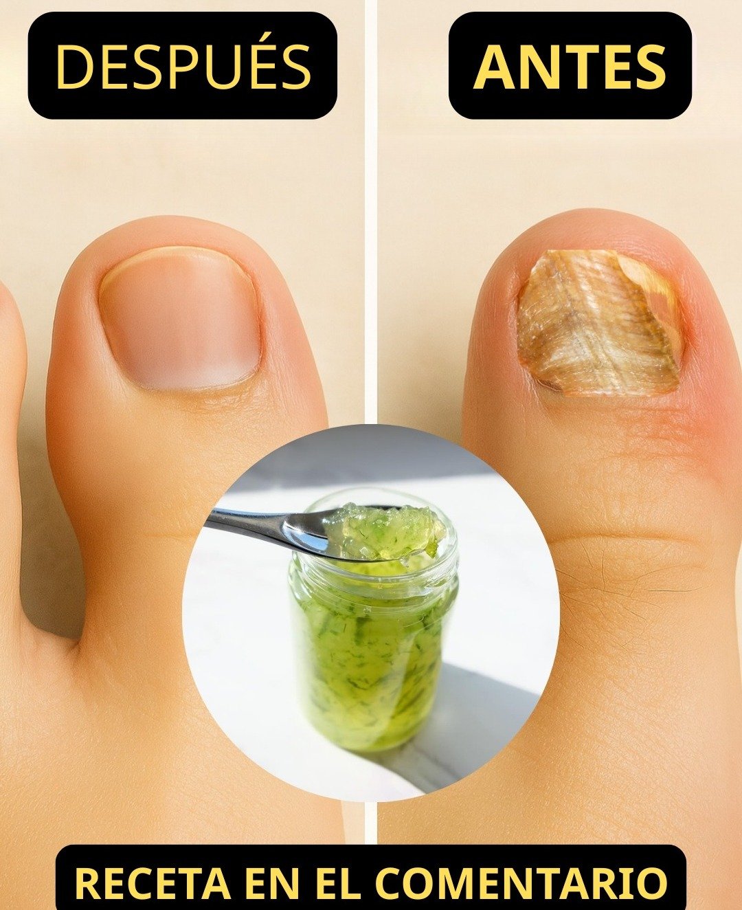 El Poder de lo Natural: Remedios Caseros para Eliminar los Hongos de Pies y Uñas