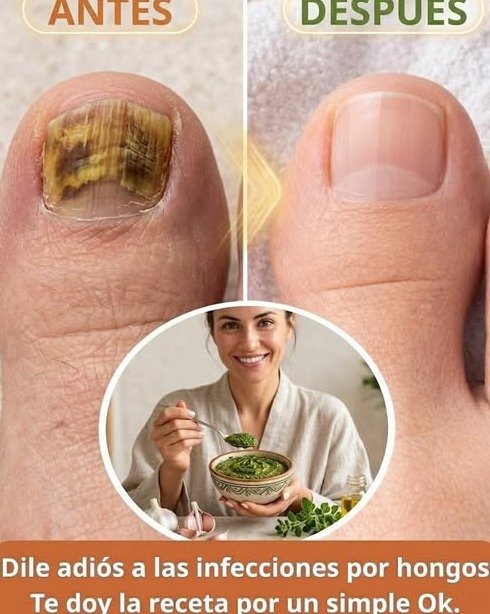 ¡Alerta! Si Tienes Hongos en Pies o Uñas, ESTO es lo Único que Debes Saber (y NADIE te lo Cuenta)