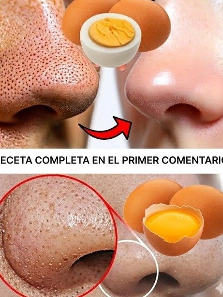 ¡ATENCIÓN! La VERDAD Oculta sobre los Puntos Negros: Lo que REALMENTE funciona y los 7 errores que te impiden eliminarlos