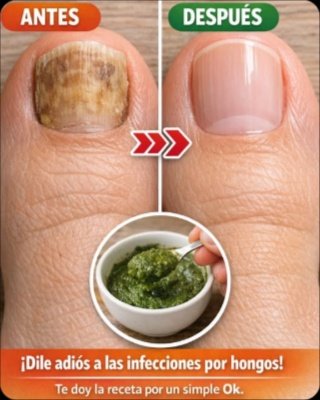 ¡BASTA YA de Hongos! Descubre el ÚNICO Método que FUNCIONA (y los Mitos que DEBES Ignorar YA)