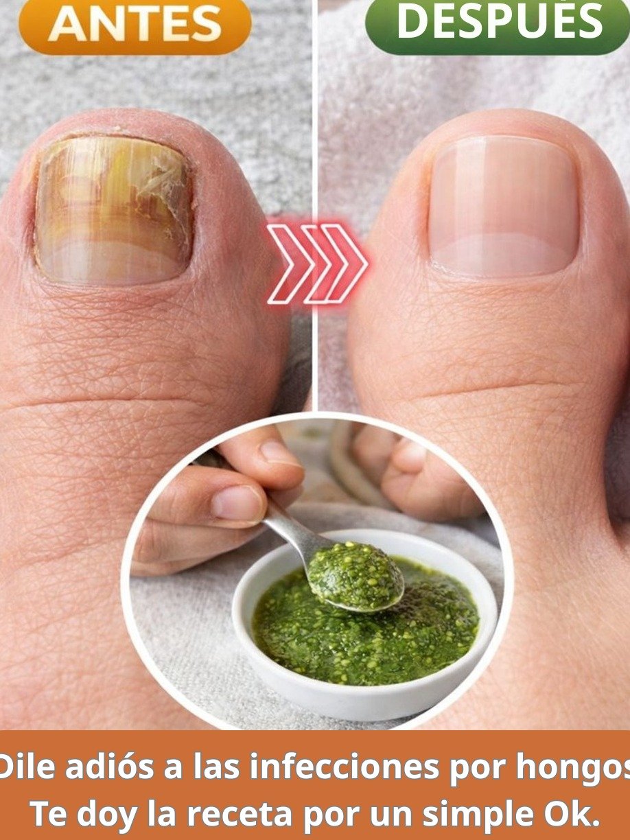 El SECRETO Ancestral de Ajo y Vinagre que Está ELIMINANDO los Hongos de Pies y Uñas en SEMANAS (¡Resultados Reales!)
