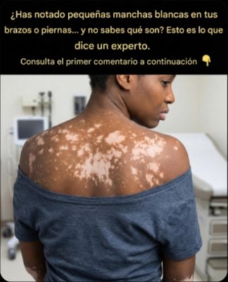 ¡Alerta Piel! ¿Manchas Blancas? Esto es lo que tu cuerpo intenta decirte (y cómo solucionarlo ANTES de que sea tarde)