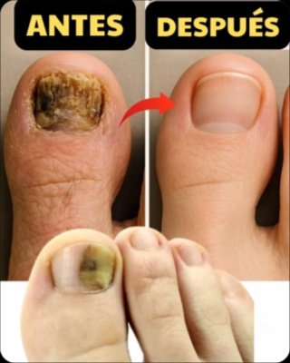 ¡El Secreto Guardado para Uñas Perfectas! Este Remedio Casero VIRAL Elimina Hongos en Tiempo Récord (¡Resultados Antes y Después que te Dejarán Sin Habla!)