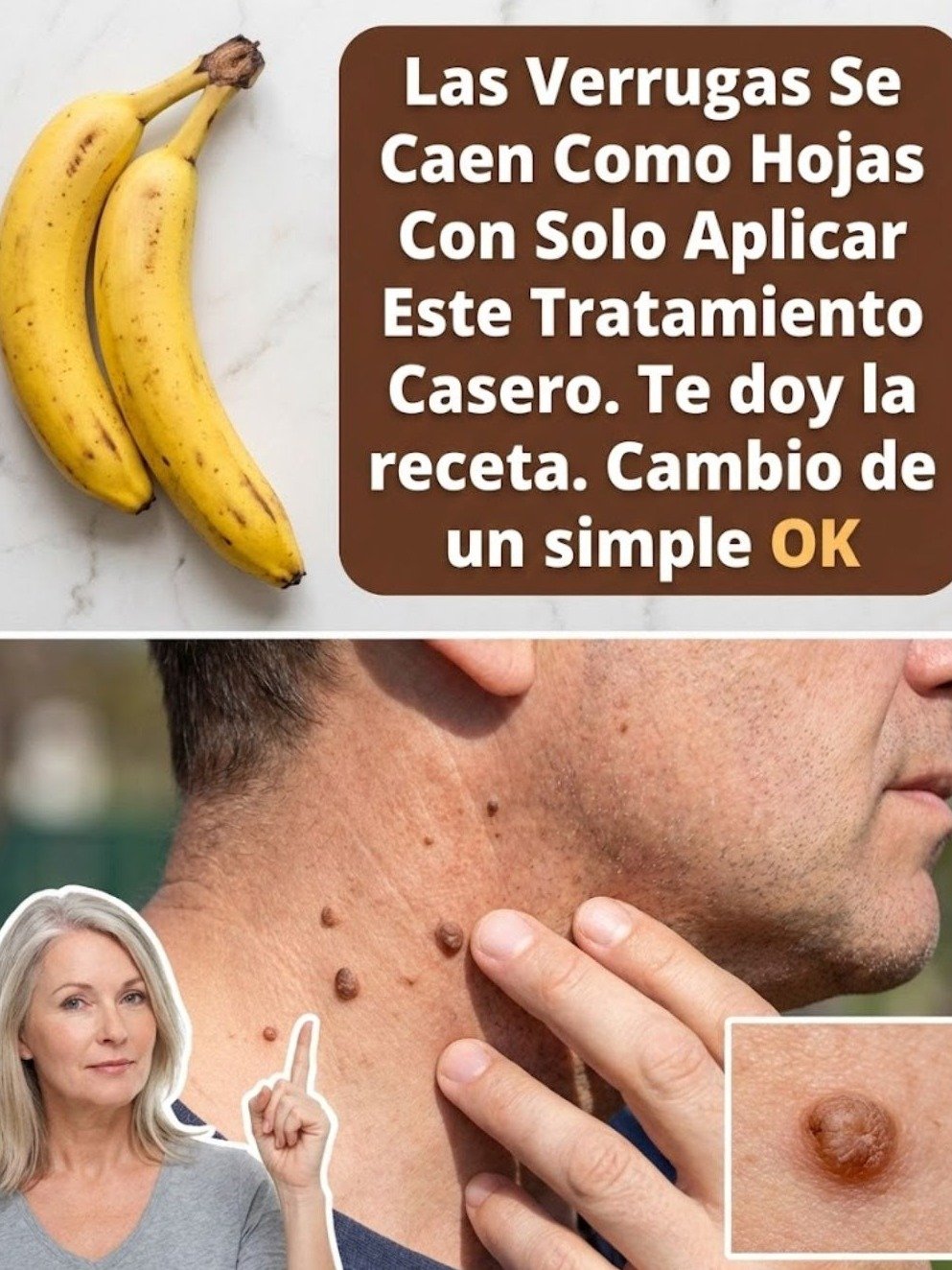 ¡Adiós Verrugas! El Secreto de la Cáscara de Plátano y 3 Ingredientes Clave que Transforma Tu Piel en Semanas