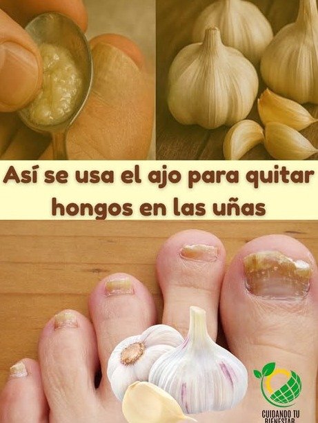 ¡STOP! ¿Ajo para Hongos en Uñas, Piel o Cuero Cabelludo? La Impactante Verdad que DEBES Saber ANTES de Aplicártelo