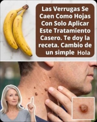 El Secreto Viral de la Cáscara de Plátano para Verrugas: ¿Mito o Solución Mágica? ¡La Verdad Oculta que DEBES Saber!