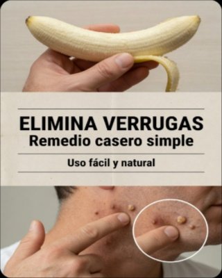 ¡El Secreto VIRAL de la Cáscara de Plátano para Verrugas que NADIE te Cuenta! ¿Funciona o es un ENGAÑO?