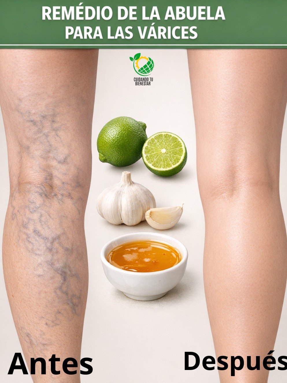 ¡El Secreto de la Abuela Revelado! Di Adiós a las Várices y Luce Piernas Espectaculares con ESTE Remedio Natural (Resultados que TE SORPRENDERÁN)