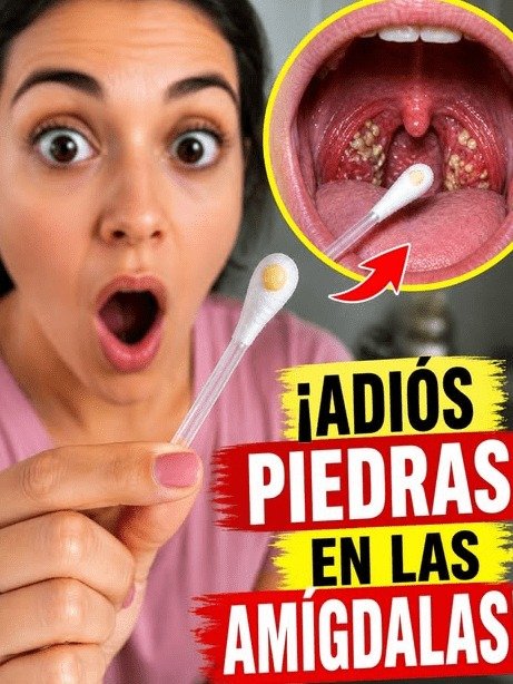 El Secreto Impactante: ¿Tu Mal Aliento NO Desaparece? ¡Podría Estar Oculto AQUÍ en Tus Amígdalas!