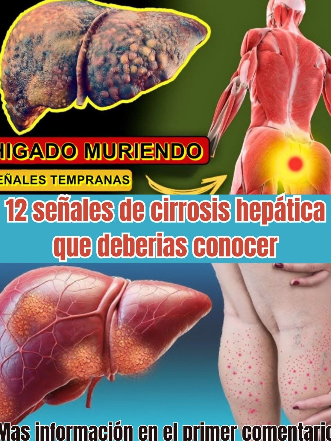 ¡URGENTE! Tu Hígado Podría Estar Fallando en Silencio: Las 12 Señales Secretas de Cirrosis que DEBES Conocer Ahora Mismo