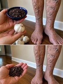 ¡Adiós Várices y Pesadez! El Secreto Ancestral con Ajo, Clavos y Jengibre Que Transformará Tus Piernas en Semanas