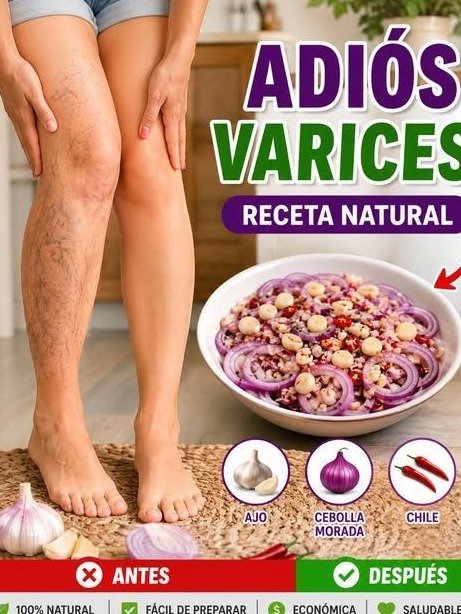 ¡El Secreto Olvidado! Cómo 3 Ingredientes de Tu Cocina Pueden Transformar Tus Venas Varicosas y Devolverle la Ligereza a Tus Piernas