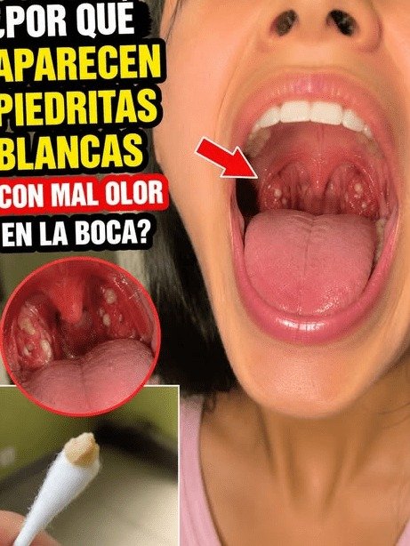 ¡ALERTA! Si tienes estas 'piedras blancas' en la boca, tu aliento te delata. Descubre cómo eliminarlas para siempre.