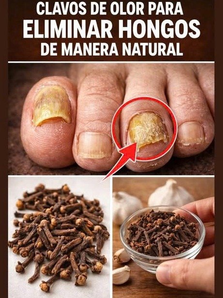 ¿Cansado de los Hongos en las Uñas? El Remedio Natural MILAGROSO que Nadie Te Ha Contado (¡Resultados en Semanas!)
