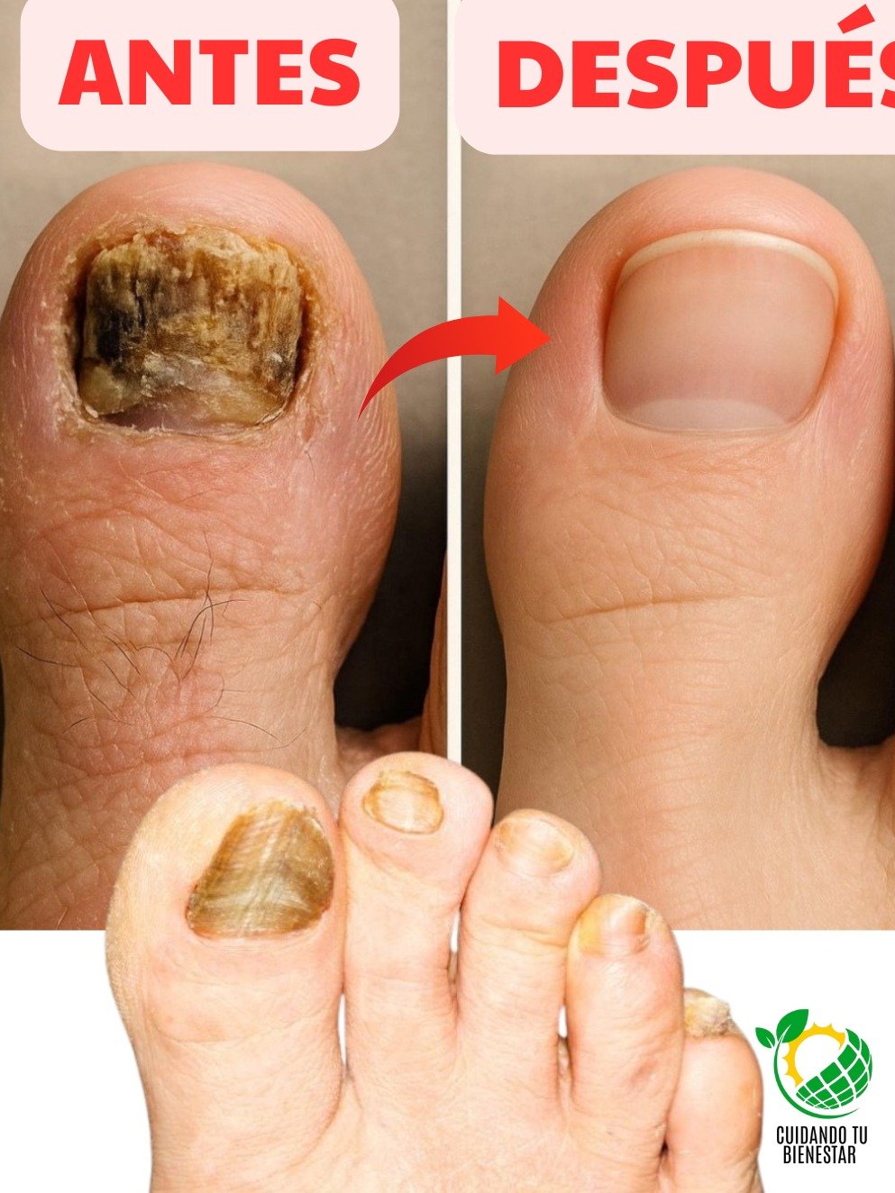 ¡El Secreto Mejor Guardado! Elimina los Hongos de las Uñas PARA SIEMPRE con Este Remedio Casero (¡Resultados ANTES y DESPUÉS que te Dejarán Sin Palabras!)