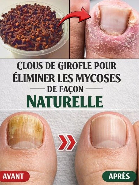 ¡Revelado! El ingrediente SECRETO de tu cocina que ELIMINARÁ los hongos de tus uñas para siempre (y no es lo que piensas)