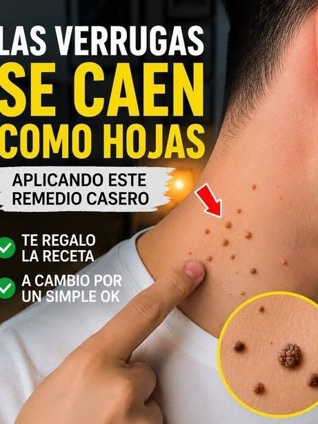 ¡Alerta Viral! El Remedio CASERO con Cáscara de Plátano que Hará CAER tus Verrugas Como Hojas Secas (¡Lo tienes en casa y funciona!)