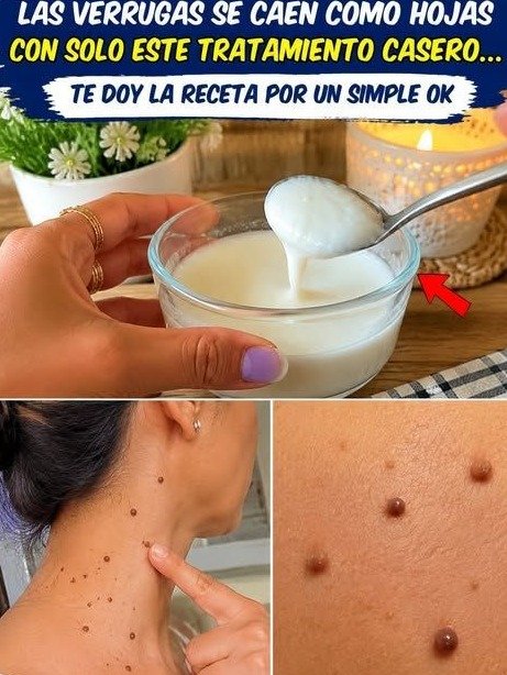 ¡ALERTA! El Secreto de las Verrugas que NADIE te Cuenta: ¿Funcionan los Remedios Caseros o Estás Cometiendo un Error Fatal?
