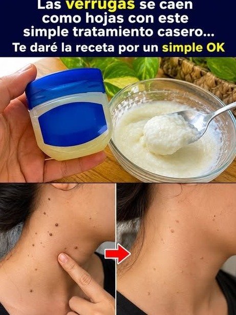 ¡Alerta Roja! Si Tienes Verrugas, Estás Ignorando ESTE Secreto Vital para tu Piel (Lo que Nadie Te Cuenta)