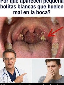 ¡Horror! ¿Esas 'Piedras Blancas' Apestosas en tu Garganta Son la Causa de tu Peor Aliento? La Solución Secreta que Pocos Conocen