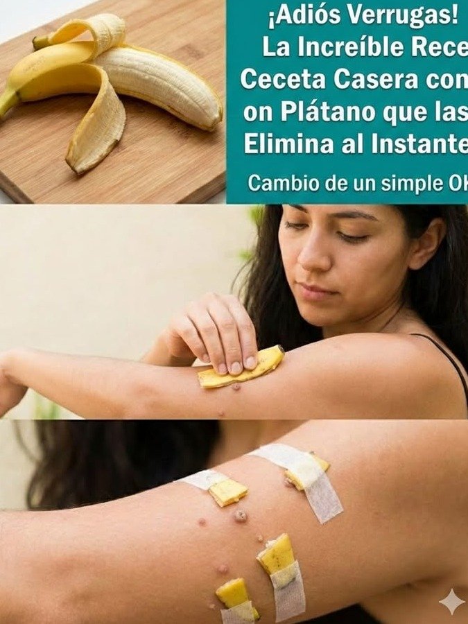 ¡No Vas a Creerlo! El Secreto Olvidado de la Cáscara de Guineo para Eliminar Verrugas (¡Miles Ya Lo Están Probando!)