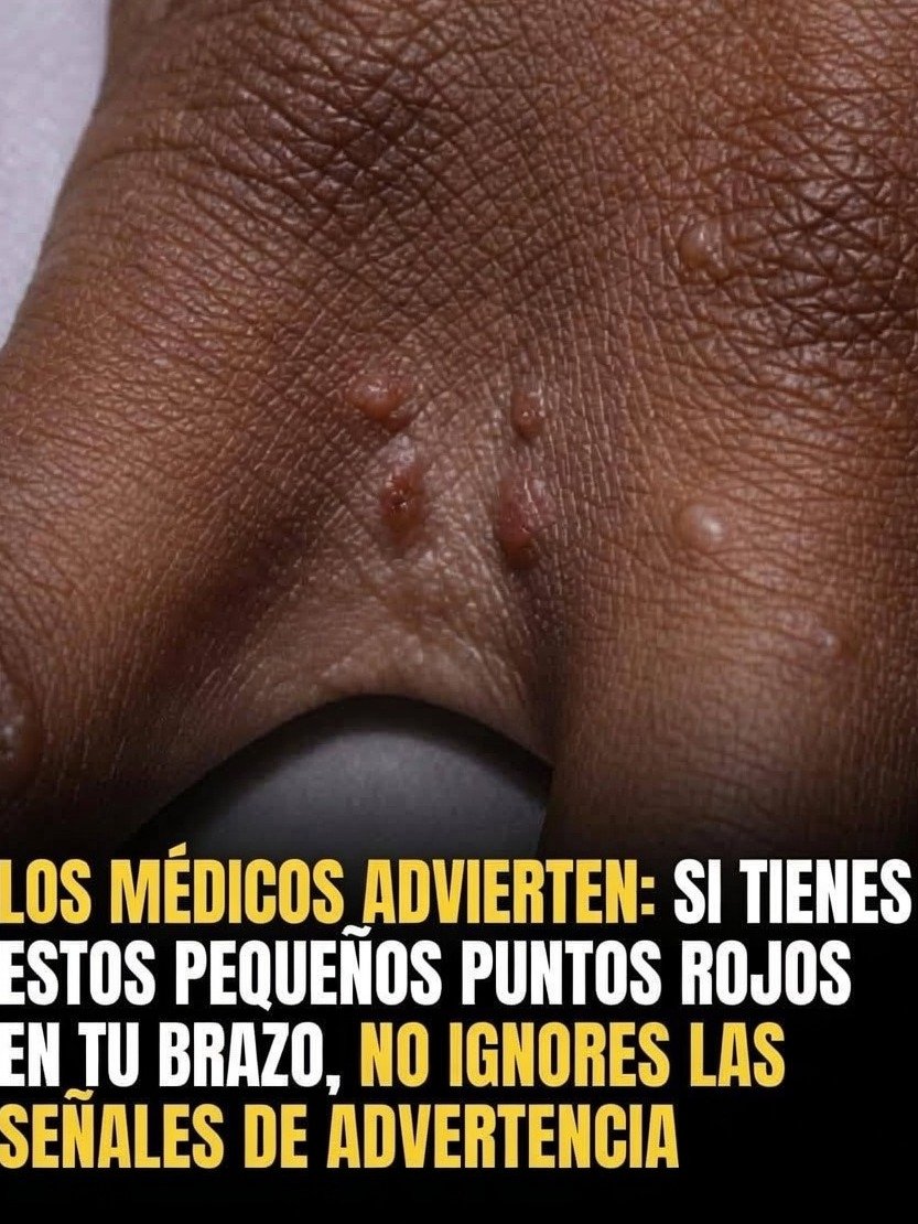 ¡ALERTA! Si Tus Manos o Pies Tienen ESTAS Ampollas Rojas Que Pican, Descubre QUÉ Significa Y Cómo Aliviarlo URGENTE