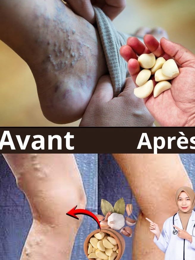 ¡El secreto mejor guardado! Cómo eliminar las varices de forma natural usando solo ajo