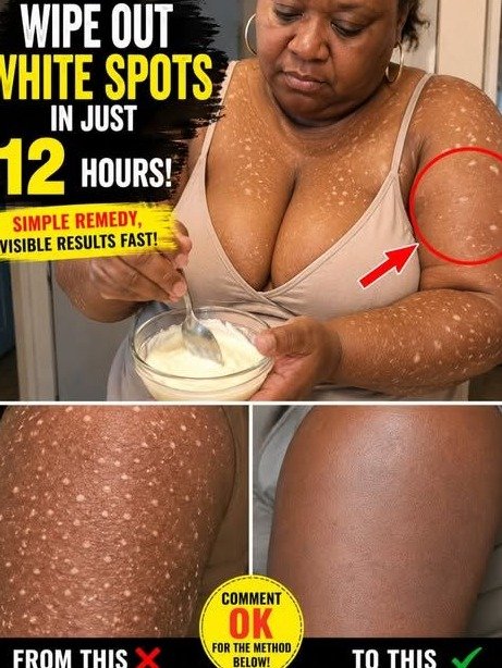 Stop Hiding Those White Spots: The Secret to Restoring Your Skin’s Natural Tone Fast