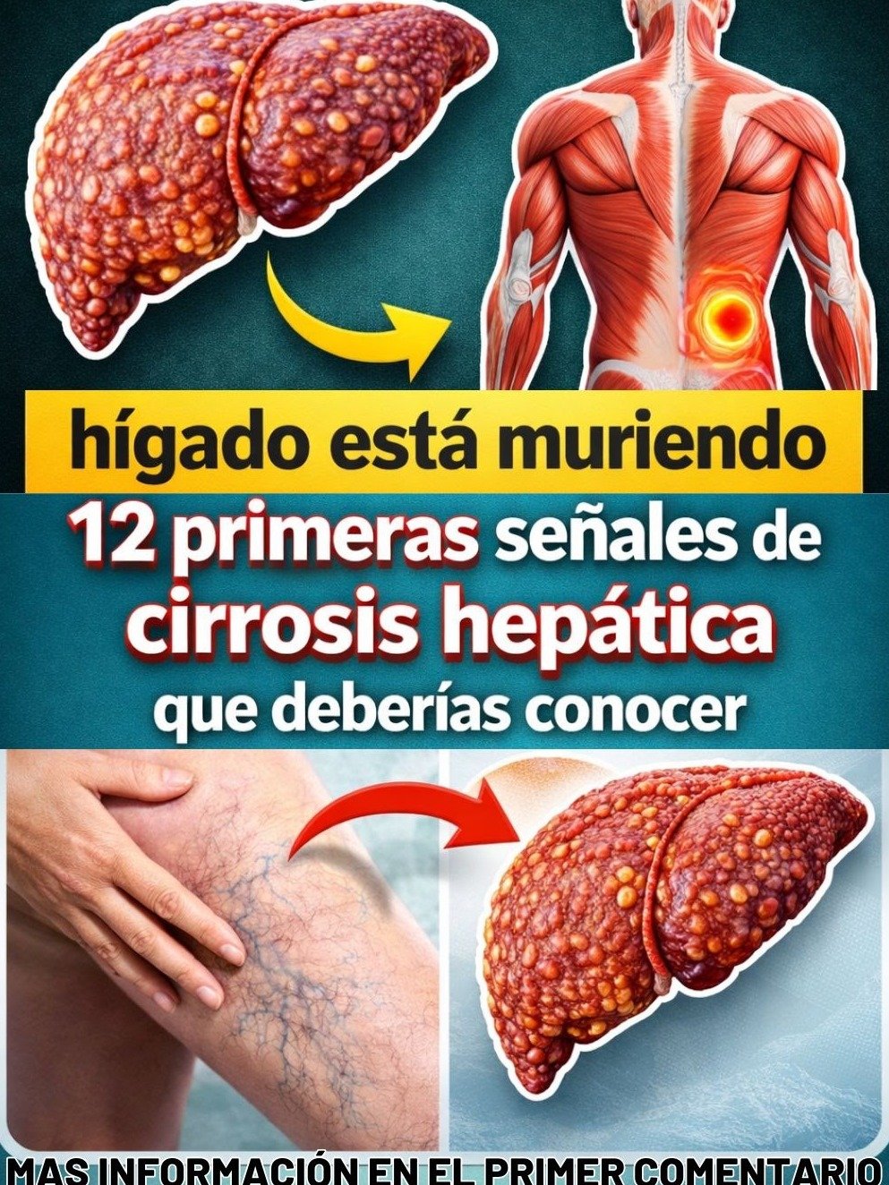¡Tu Hígado te Pide Auxilio! Descubre las 12 Señales SILENCIOSAS de Cirrosis que NUNCA Debes Ignorar