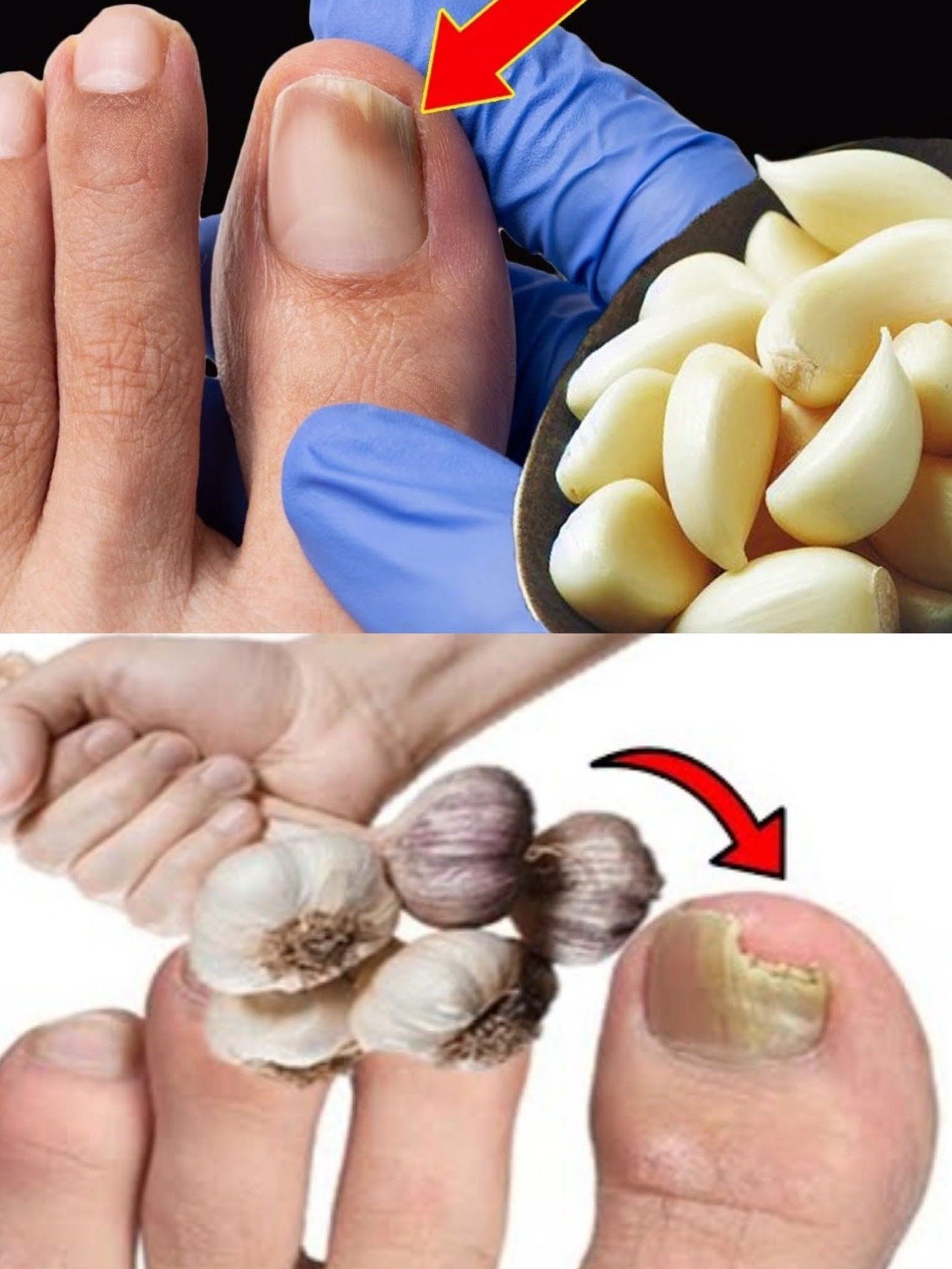 ¡Adiós Hongos de Uñas! El Remedio Casero Ultra Rápido que NADIE Te Ha Contado (Funciona en Días)