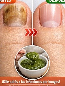 ¡No Vas a Creerlo! El Remedio Casero de Ajo y Vinagre que Está Eliminando los Hongos en Pies y Uñas (y POR QUÉ Deberías Probarlo YA)