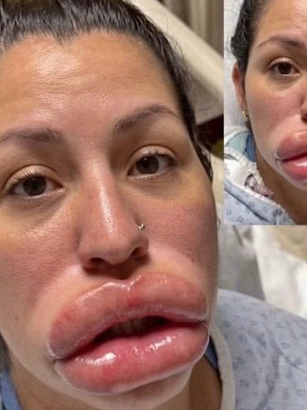 ¡Impactante Alerta! Su 'Retoque' Facial se Convirtió en PESADILLA y el Médico DESAPARECIÓ: La Verdad Detrás de la Denuncia que Estremeció a Todos