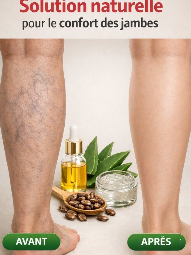 ¡El Secreto de la Abuela Revelado! Elimina las Varices y Transforma tus Piernas con SOLO 3 Ingredientes Caseros