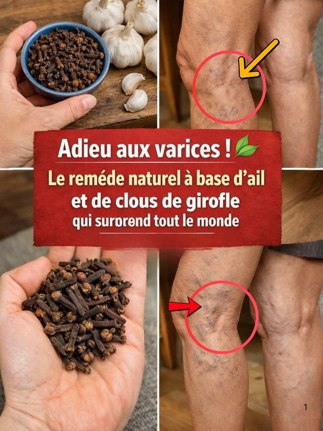 ¡Descubre el Secreto Olvidado! Ajo y Clavos de Olor: Tu Remedio Casero Definitivo para Eliminar Varices y Revitalizar tu Circulación