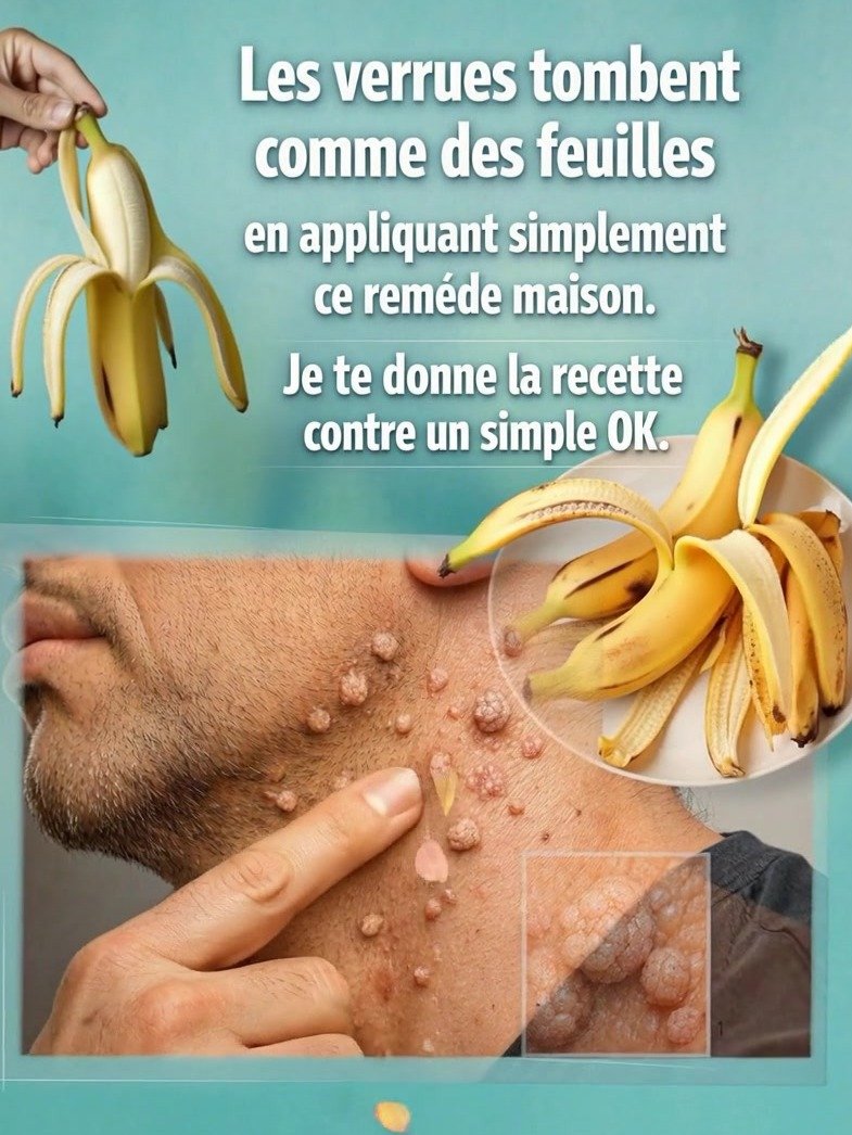 ¡Adiós Verrugas para Siempre! El Secreto VIRAL de la Cáscara de Plátano que las Hará Desaparecer Sin Dolor (Nadie te lo había contado)