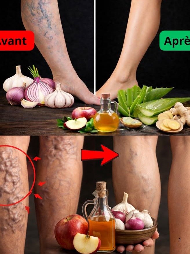 ¡El Secreto Olvidado para Piernas Sin Várices! 😱 Descubre CÓMO Cebolla, Ajo y Vinagre de Manzana Transformarán Tu Vida (¡No Te Lo Pierdas!)
