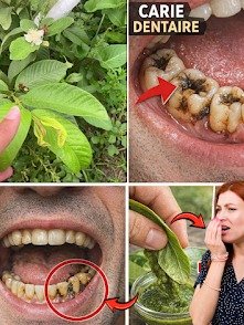 ¡No Más Caries! Descubre las 3 Maneras Asombrosas de Usar Hojas de Guayaba para una Salud Dental de Envidiable (Tu Sonrisa lo Notará)